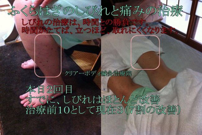 足のふくらはぎのしびれと痛みの治療 1回目終了後5日 福岡県宗像市在住