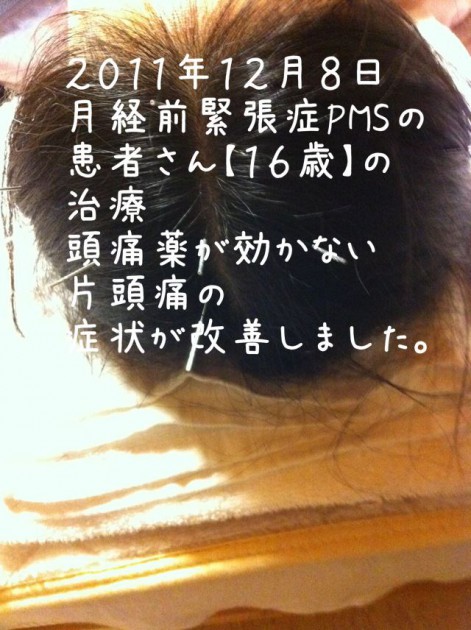 月経前緊張症(PMS)の患者さん【16歳】の治療