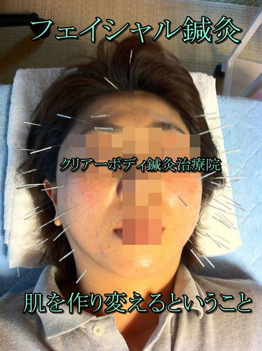 フェイシャル鍼灸 美容鍼針 肌を作り変えるということ 福岡県福津古賀北九州市 クリアーボディ鍼灸治療院