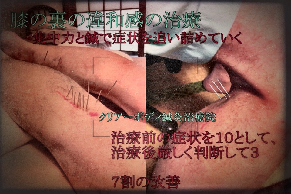 ふくらはぎ・ハムストリング・膝裏の治療
